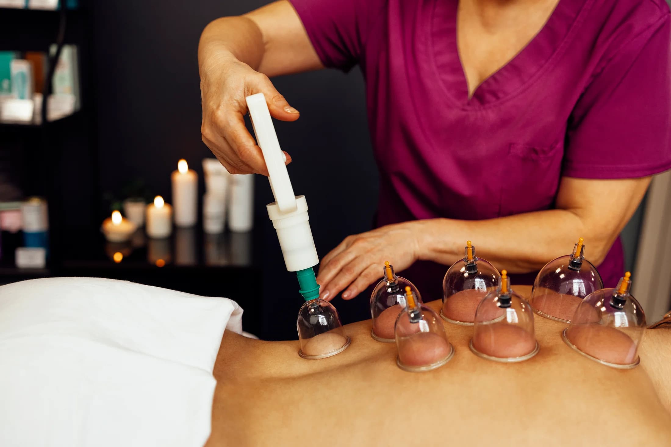 Therapist applying suction cups along a client's back during cupping therapy